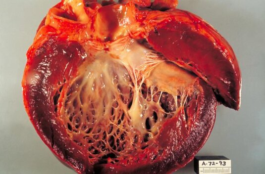 Hypertrophe Kardiomyopathie